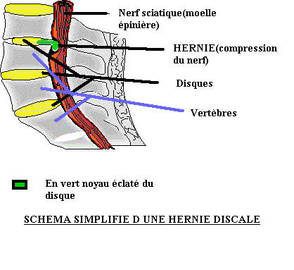 Le traitement de la hernie intervertébrale du service lombaire deksametazonom