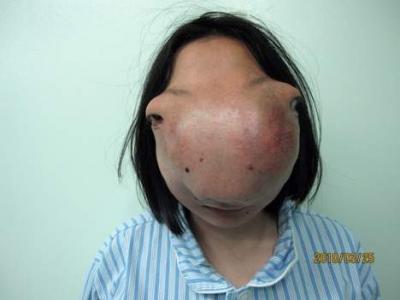 Wu Xiaoyan à une tumeur incroyable qui déforme son visage