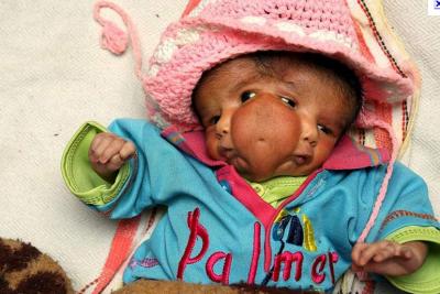 Que pensez vous du bébé à deux visages ( inde )