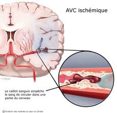 Que pensez vous des accident vasculaire cérébral (AVC)